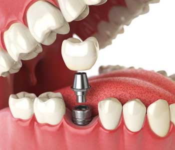 What to Expect with Dental Implants in Carrollton