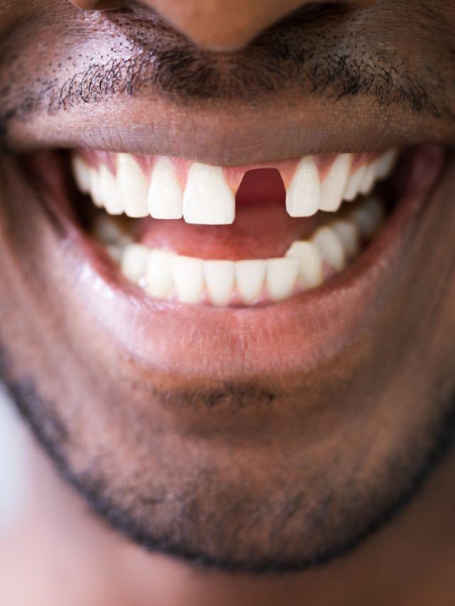 Missing teeth can affect your oral health and change your appearance.