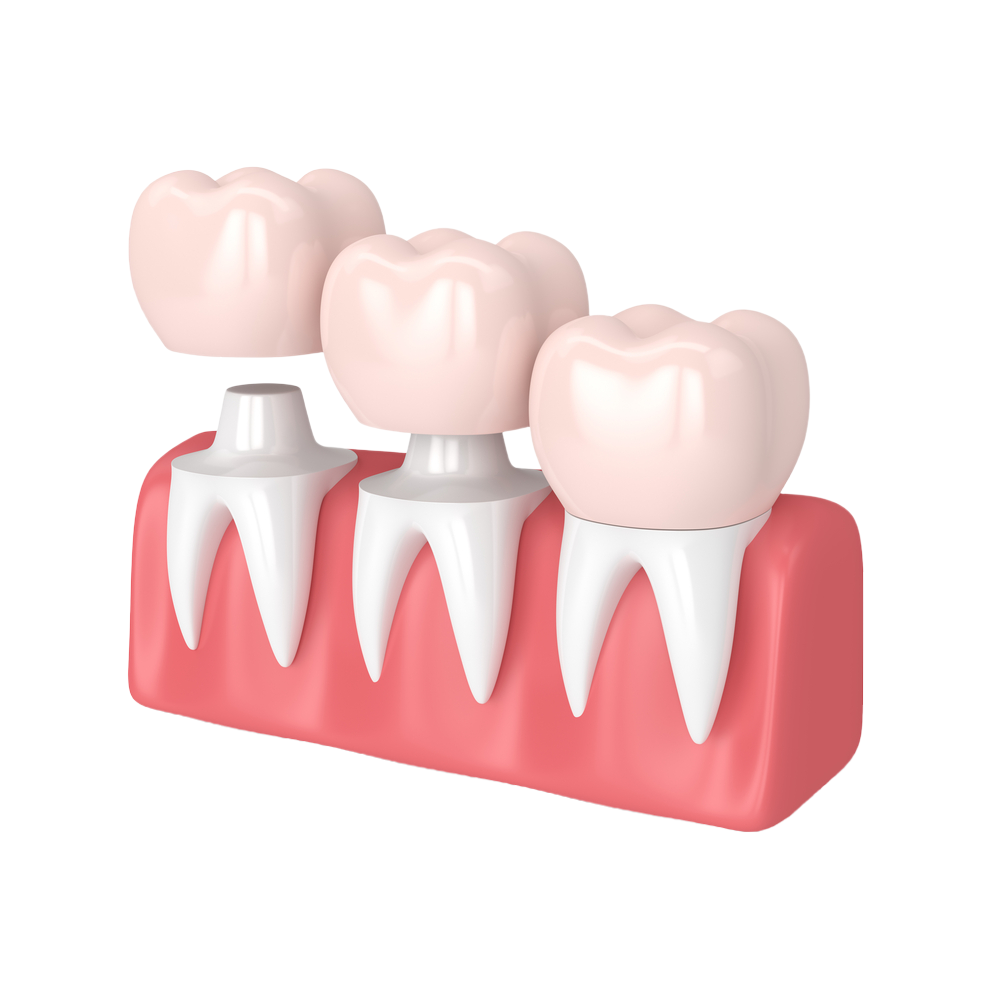 Dental crowns and bridges home page image