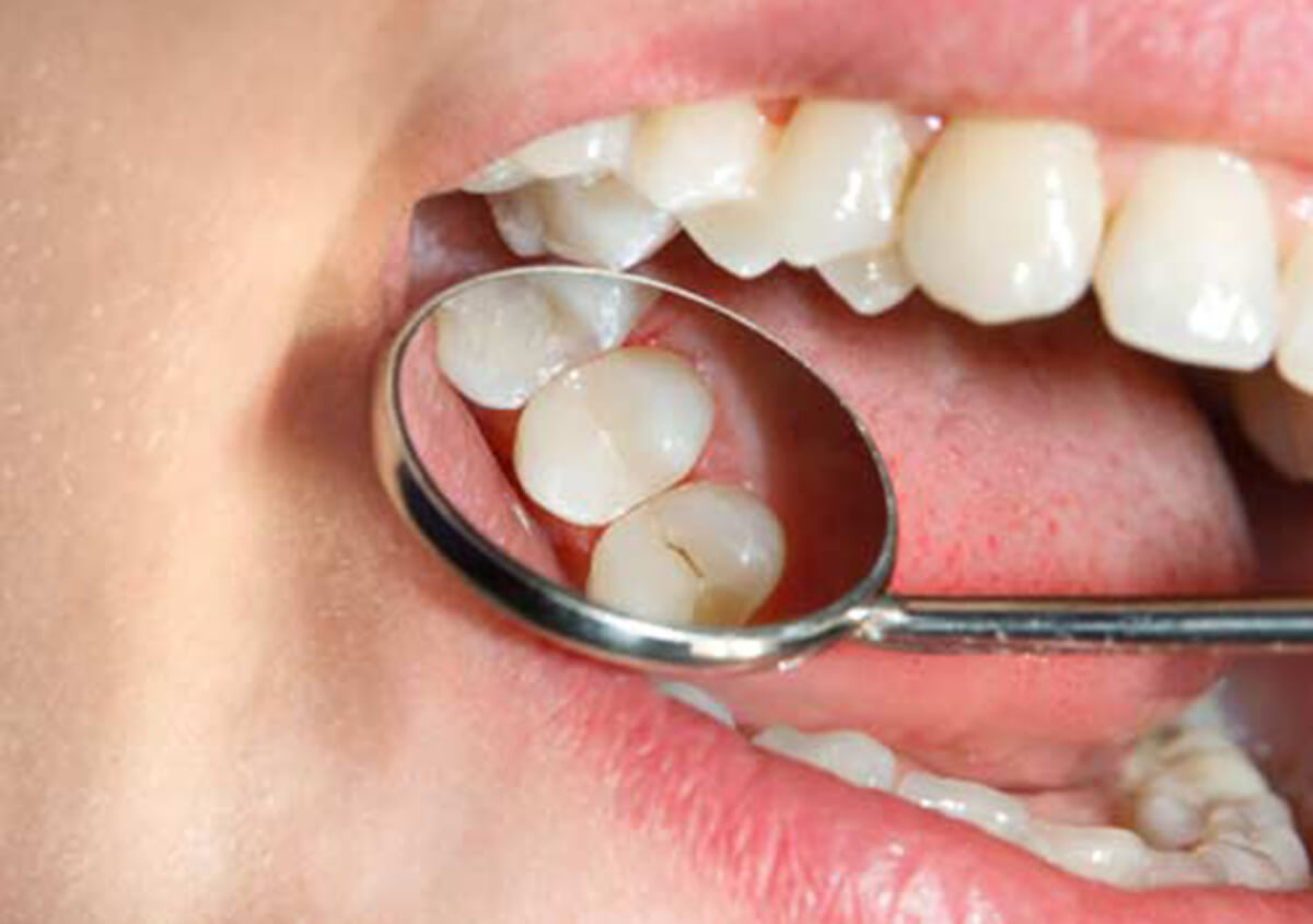 EXPERIENCE THE ADVANTAGES OF COMPOSITE FILLINGS THAT PROMOTE ORAL HEALTH