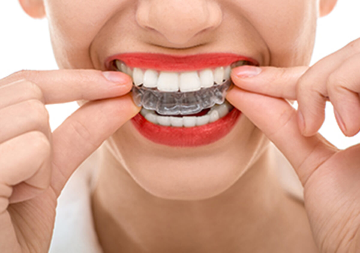 Dr. Adnan Saleem at Hebron Smiles offers options for clear braces on teeth near Carrollton, TX