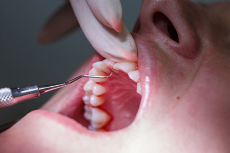 WHY PATIENTS MAY NEED WISDOM TEETH EXTRACTION