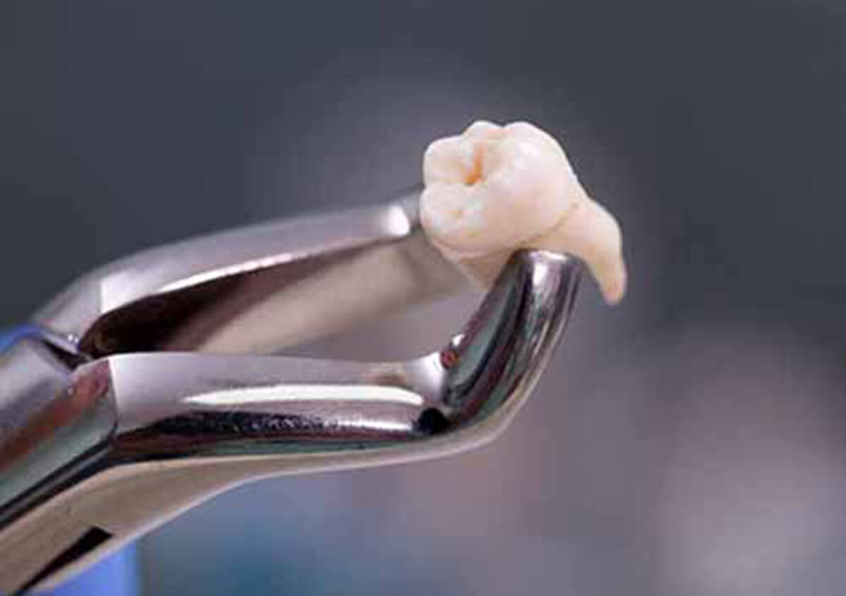 At Hebron smiles, offer dental extraction treatment for wisdom teeth in our Carrollton, TX office.