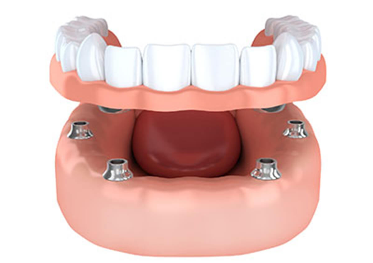 IMPLANT DENTURES ARE AN EXCELLENT TOOTH RESTORATION OPTION FOR MISSING TEETH