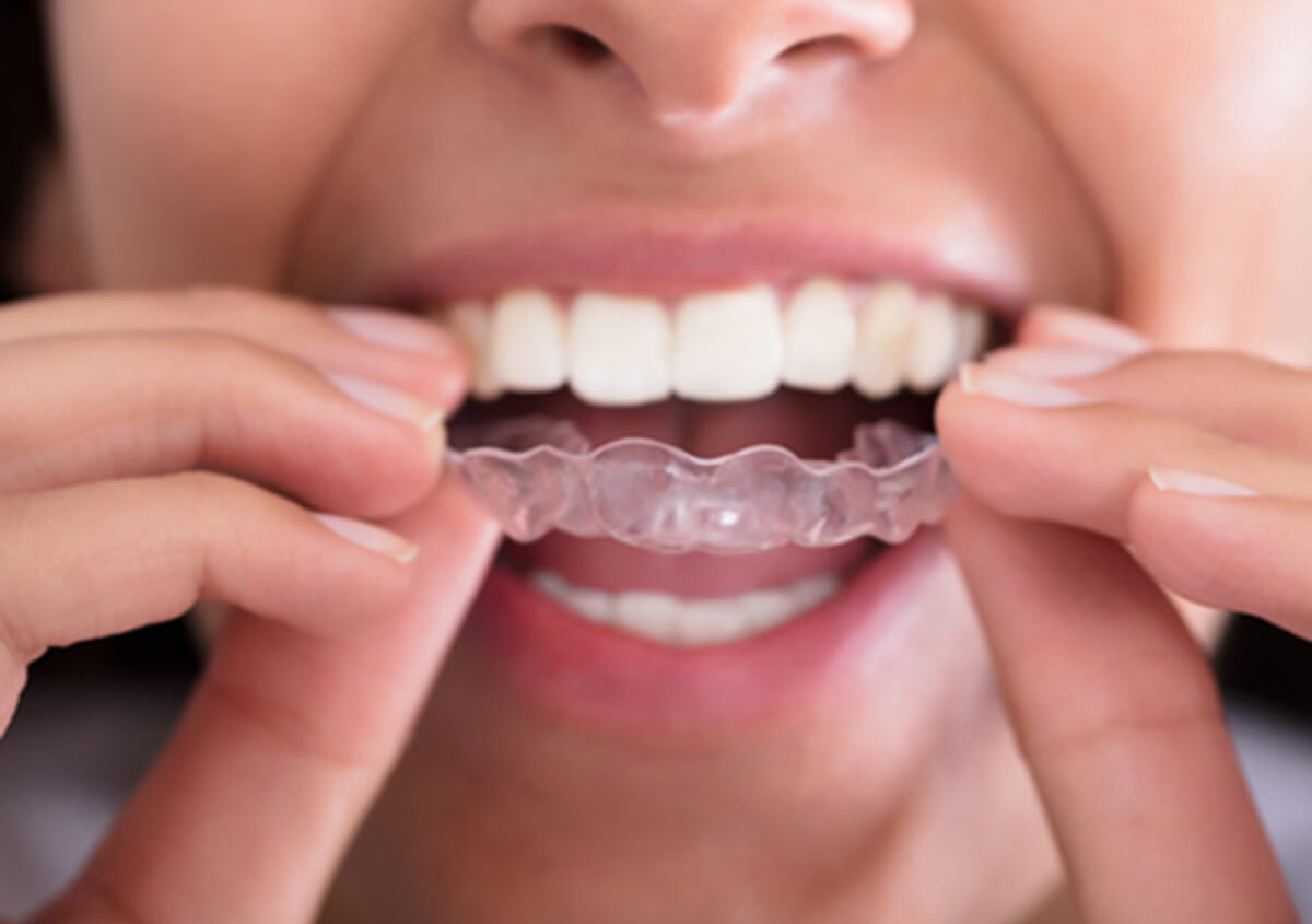 Invisalign Will Change Your Life and Smile Carrollton in Carrollton area