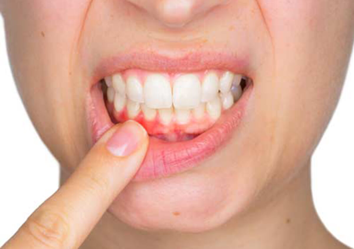 Young woman showing with her finger inflamed lower gingiva with pain expression