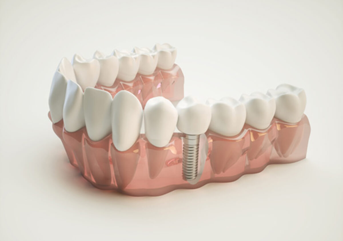 Tooth Replacement Cost and Benefits in Carrollton area