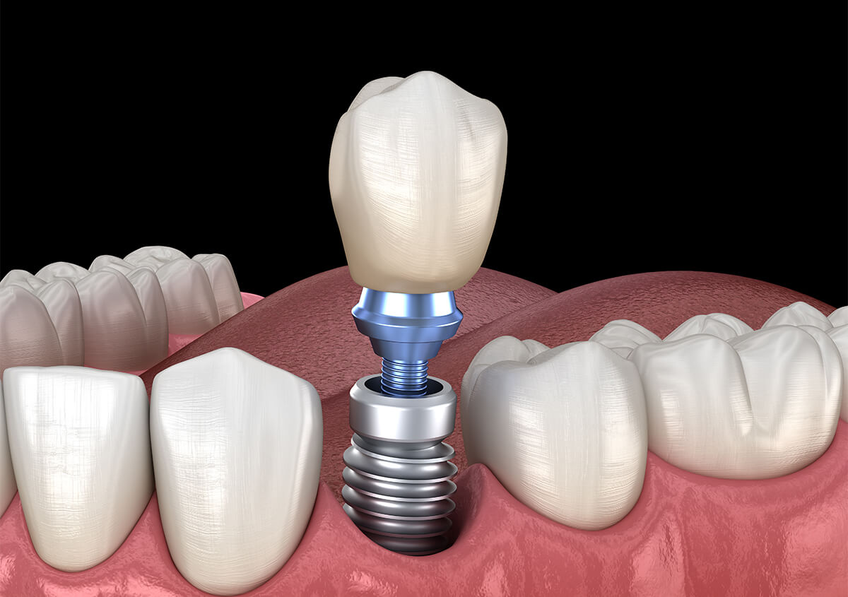 Teeth Implants Dentist in Carrollton TX Area