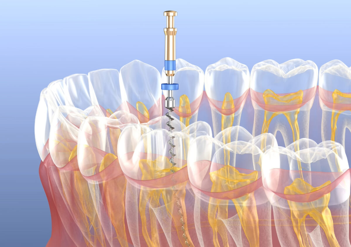 Root Canal in Carrollton TX area